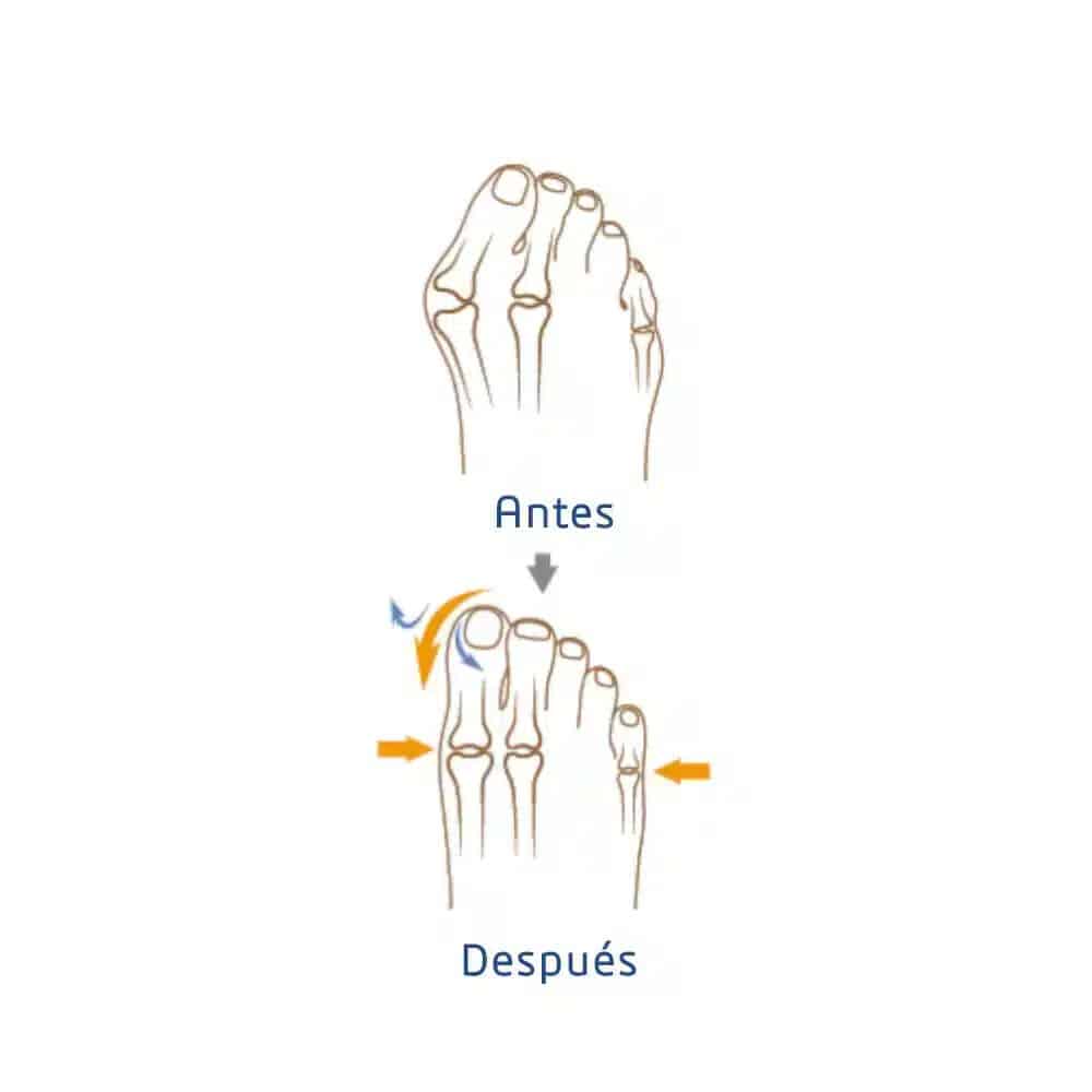Hallux Valgus korrigerare höger L och XL Före och efter Hallux Valgus korrigerare höger L och XL