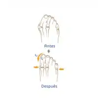 Before and after Hallux Valgus corrector right L and XL