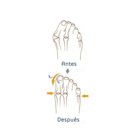 Effektiv korrigering av snedställd stortå Hallux Valgus korrigerare höger L och XL Före och efter Hallux Valgus korrigerare höger L och XL